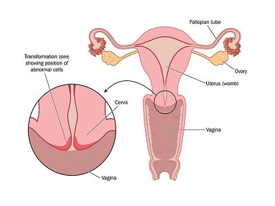 Cancer of Uterus and Cervix