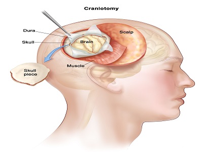 Brain Cancer treartment