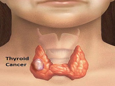Thyroid cancer treatment